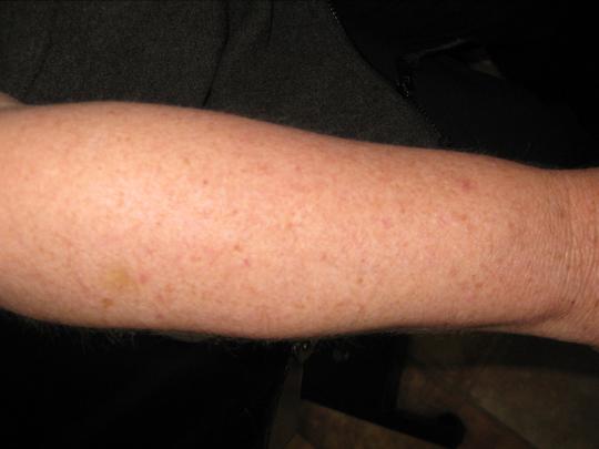 woman's arm after electrolysis