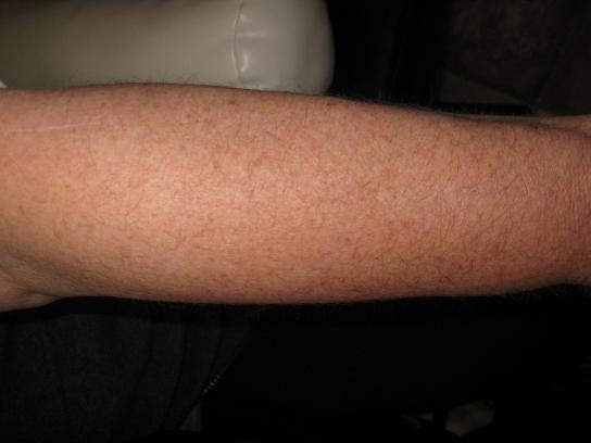 woman's arm before electrolysis